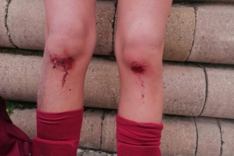 Heridas en las rodillas de un jugador de la ADC Parque Sureste causadas, presuntamente, por el mal estado del césped del campo Casa Grande